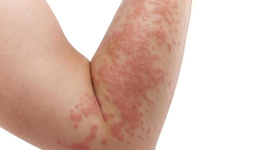 Phenergan used for Phenergan used for