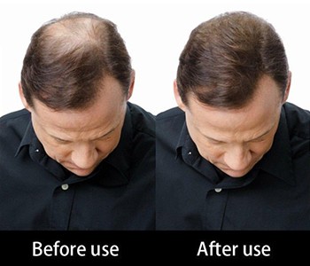 Нема више бриге о ћелавости! Нова стратегија превенције и лечења опадања косе...