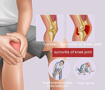 Шта узрокује артритис?